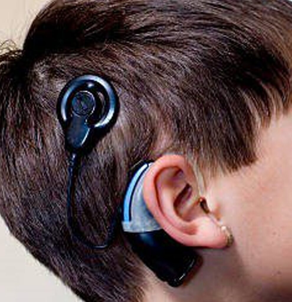 Cochlear implants