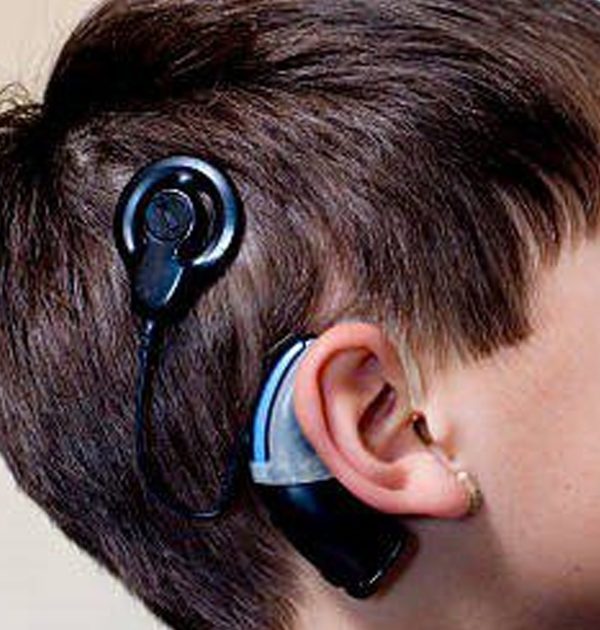 Cochlear Implant 1